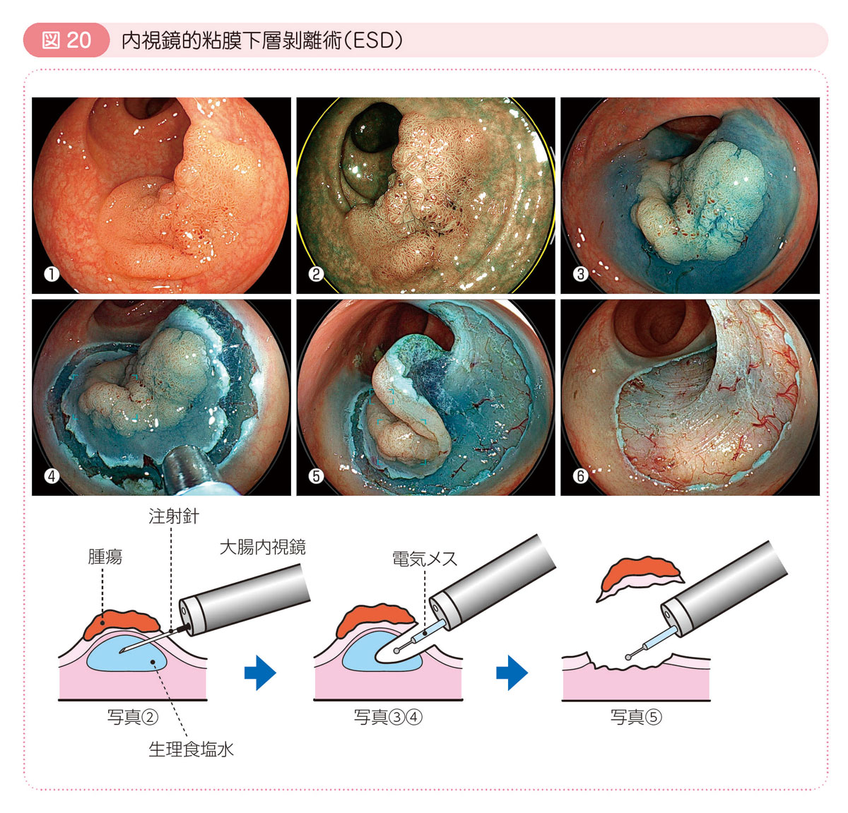 図20 内視鏡的粘膜下層剥離術（ESD）