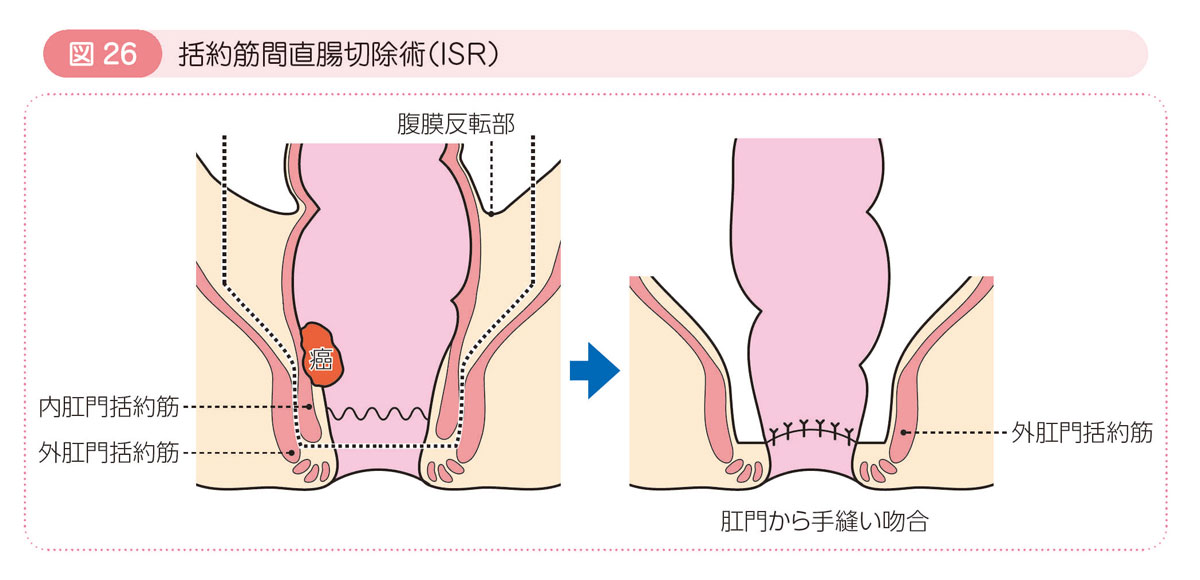 図26 括約筋間直腸切除術（ISR）