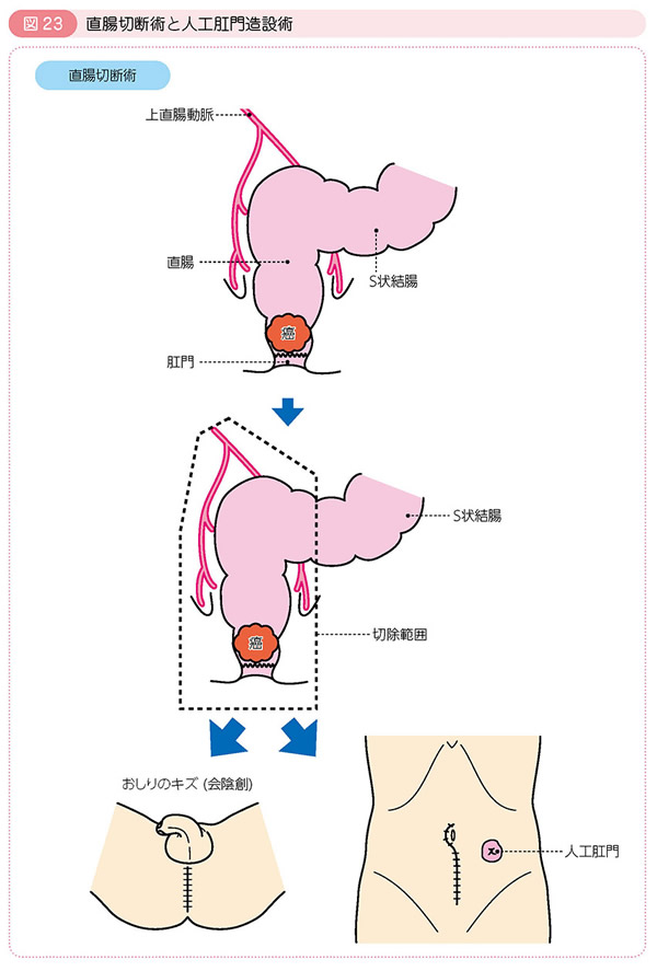 図23 直腸切断術と人工肛門造設術