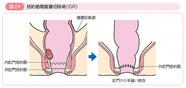 図24 括約筋間直腸切除術（ISR）