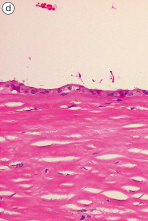 低異型度の粘液嚢胞腺腫d