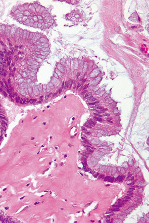 腹膜偽粘液腫を伴う粘液嚢胞腺腫d
