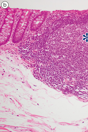正常粘膜におけるリンパ濾胞b