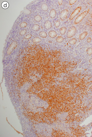 大腸マントル細胞リンパ腫d