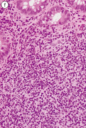 大腸マントル細胞リンパ腫f