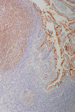 大腸濾胞リンパ腫c