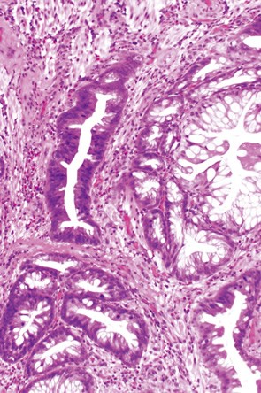Mucosal prolapse syndrome（MPS）,（polypectomy）b