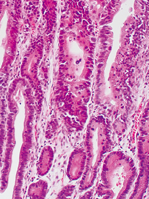 basal cell type neoplasia