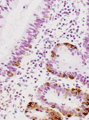 pancellular type neoplasia