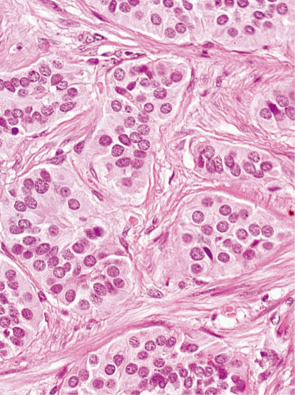 カルチノイド（carcinoid tumor）
