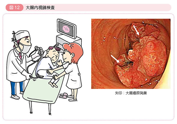 図12 大腸内視鏡検査