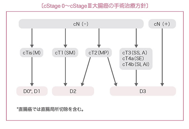 cStage 0～cStage III大腸癌の手術治療方針