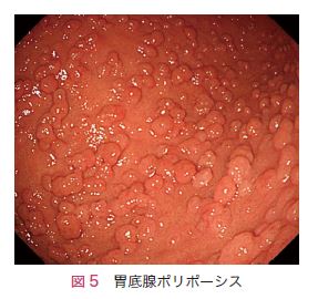図5　胃底腺ポリポーシス