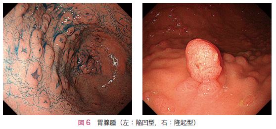 図6　胃腺腫（左：陥凹型，右：隆起型）