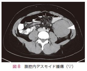 図8　腹腔内デスモイド腫瘍（▽）