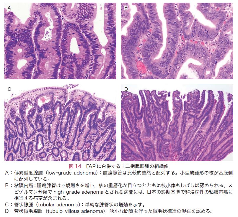 図14　FAPに合併する十二指腸腺腫の組織像