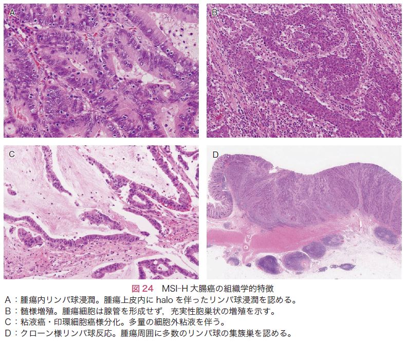 図24　MSI-H大腸癌の組織学的特徴