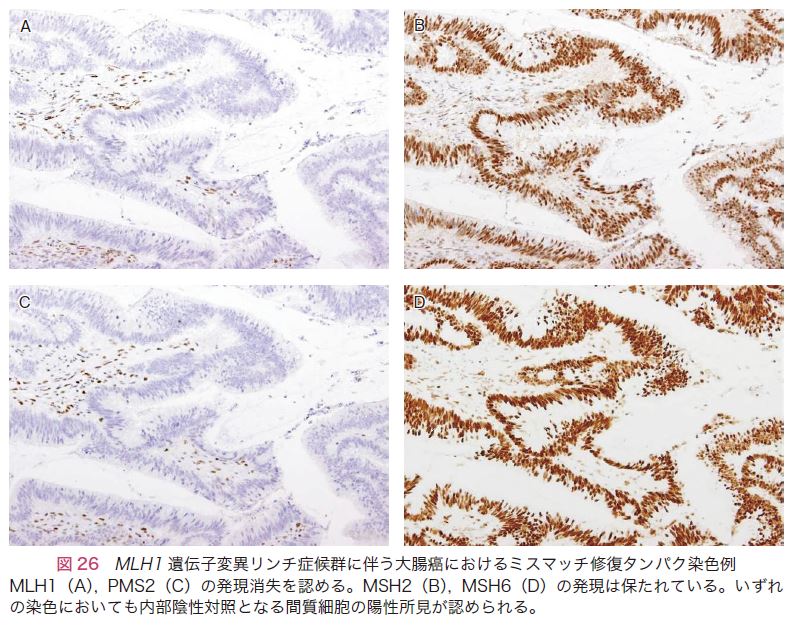 図26　<i>MLH1</i>遺伝子変異リンチ症候群に伴う大腸癌におけるミスマッチ修復タンパク染色例