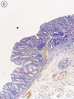 無茎性塊状粘膜下浸潤癌（いわゆるIs ＋ IIc）癌
