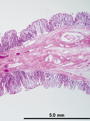 Colonic muco-submucosal elongated polyp