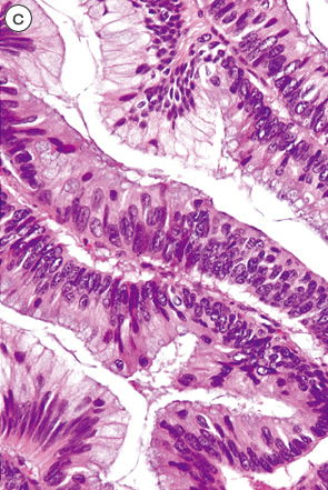 腺腫成分を伴う粘液嚢胞腺癌c