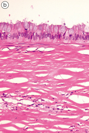低異型度の粘液嚢胞腺腫b