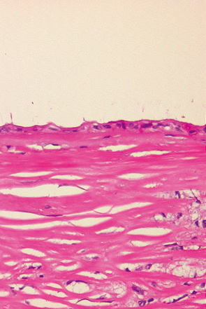 低異型度の粘液嚢胞腺腫d