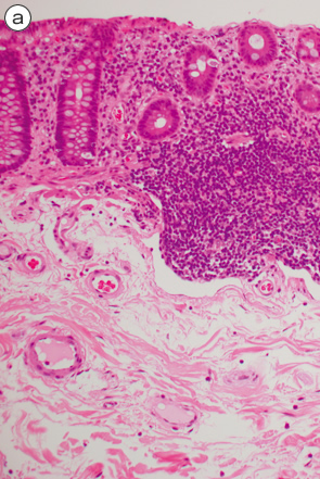 正常粘膜におけるリンパ濾胞a
