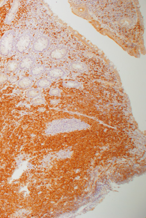 大腸マントル細胞リンパ腫c