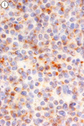 大腸腸管症型T細胞リンパ腫