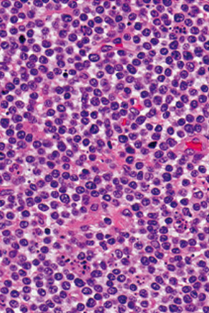 大腸腸管症型T細胞リンパ腫