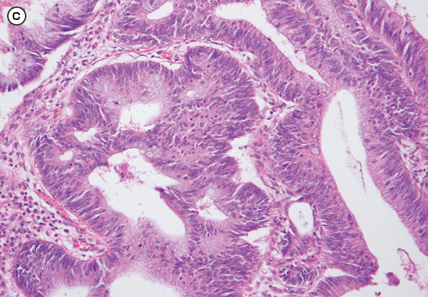 組織像。高円柱上皮，重積性のある核など典型的な大腸腺癌の像である。