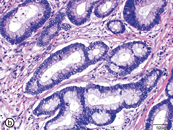癌の粘膜下層浸潤部