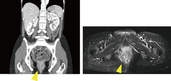 肛門がん手術に代わる手術