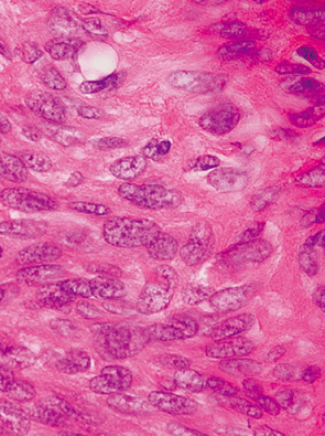 胃腸管間質腫瘍（gastrointestinal stromal tumor：GIST）
