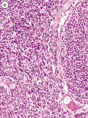 内分泌細胞癌（endocrine cell carcinoma）