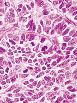内分泌細胞癌（endocrine cell carcinoma）